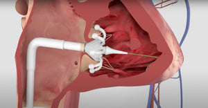 Heartening News: FDA Approves Breakthrough Tricuspid Valve Replacement System! - Heart Sound Solutions